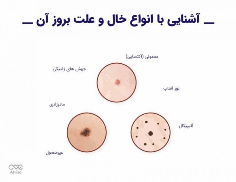 آشنایی با انواع خال و علت بروز خال در بدن | کلینیک تخصصی پوست و مو آتریسا