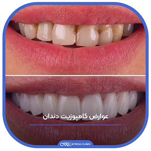 چالش های رایج مرتبط با کامپوزیت دندان