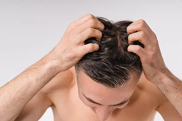 علت‌‌های اصلی ریزش مو در مردان