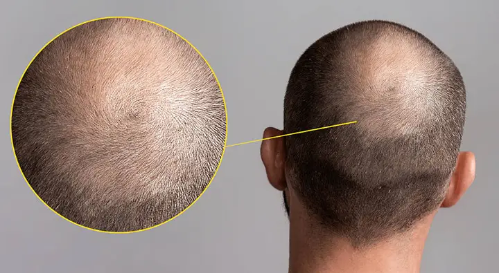 کاشت مو در فرق سر یا ناحیه ورتکس