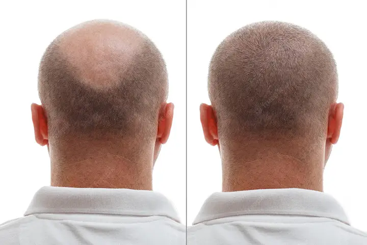 کاشت مو در فرق سر یا ناحیه ورتکس